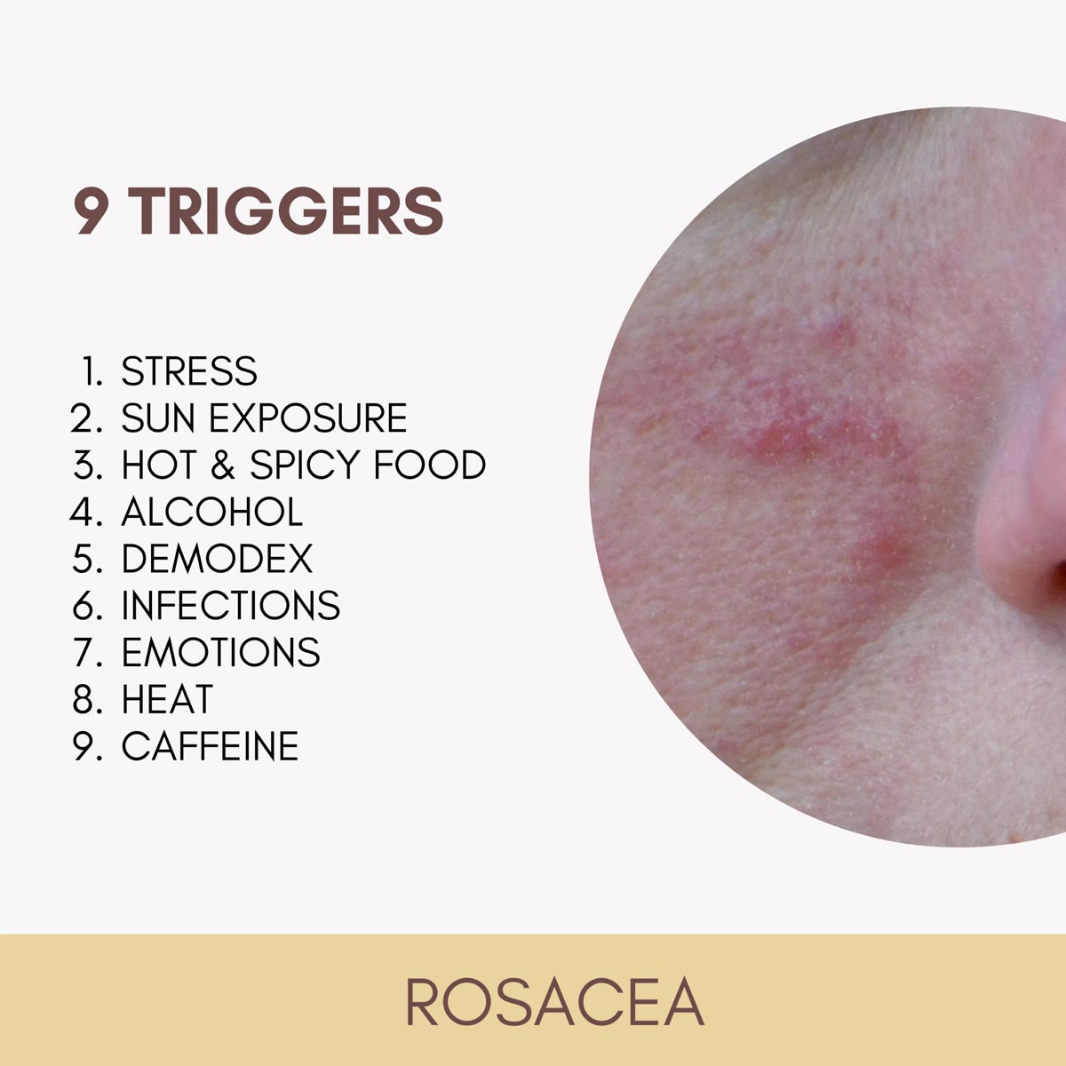 Was sind Rosacea trigger?